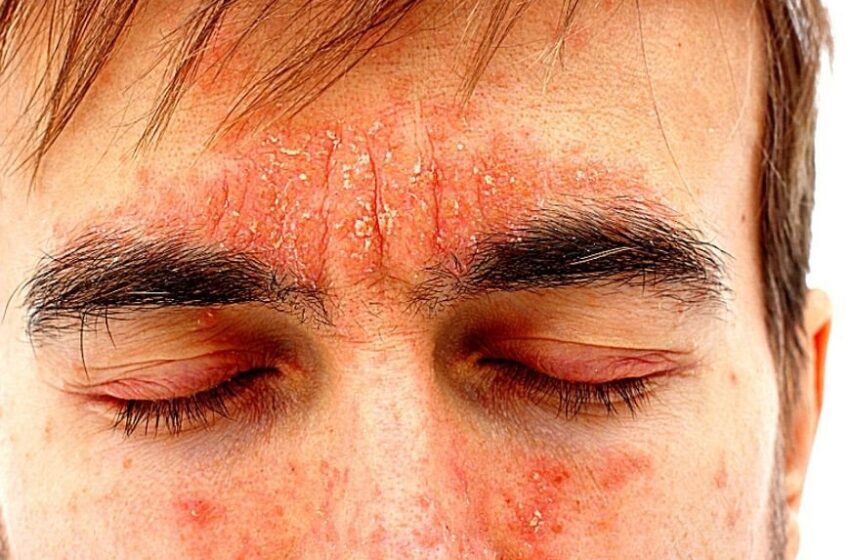  Reteta pentru vitiligo, remedii si crema preparata acasa  pentru psoriazis