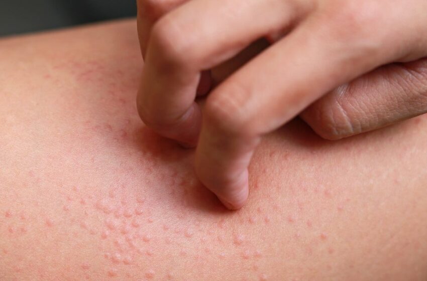  Remedii naturiste in caz de alergie, prurit, urticarie, dermatite