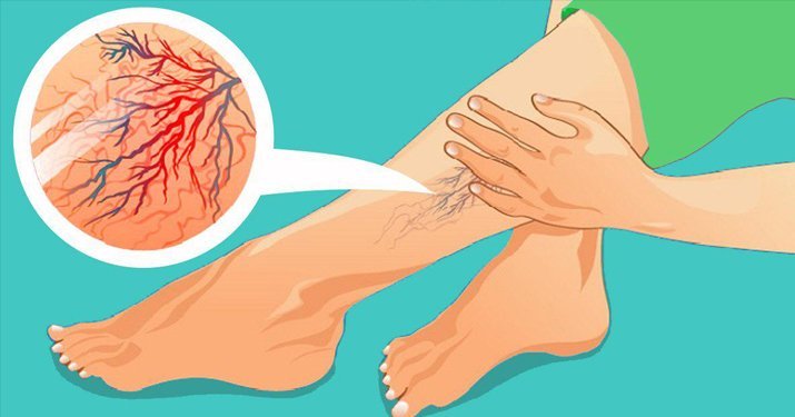  10 remedii excelente pentru varice