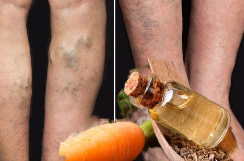  Remediu bătrânesc pentru varice  și remedii pentru negi ,impetigo, arsuri.