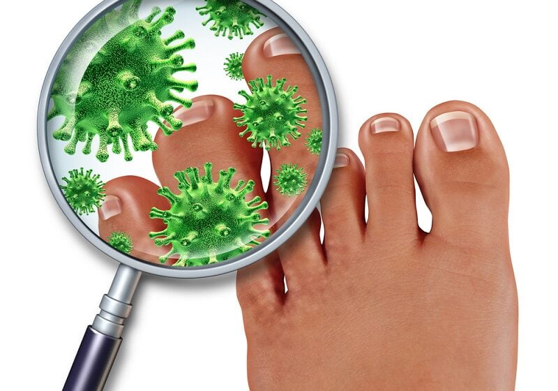  Cum sa scapi de ciuperca unghiei acasa cu remedii  naturale