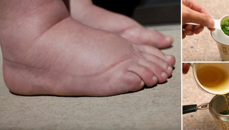  Motivele picioarelor și a mâinilor umflate dimineața și remedii care sa va ajute.
