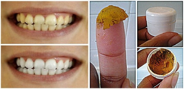  Reteta de pasta de dinți cu curcuma, pentru tratarea și albirea dintilor