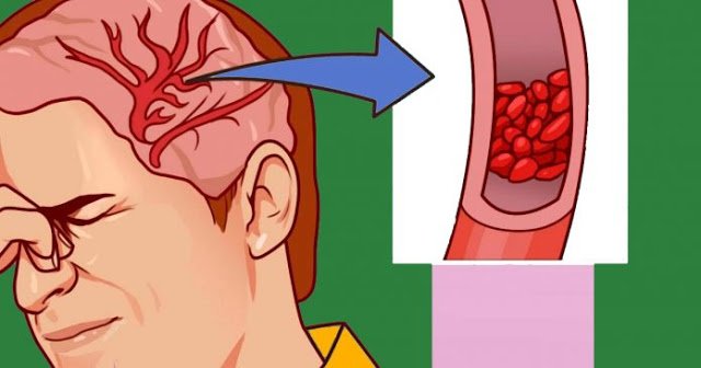  7 semnale timpurii pe care nu le poți ignora în cazul unui atac cerebral