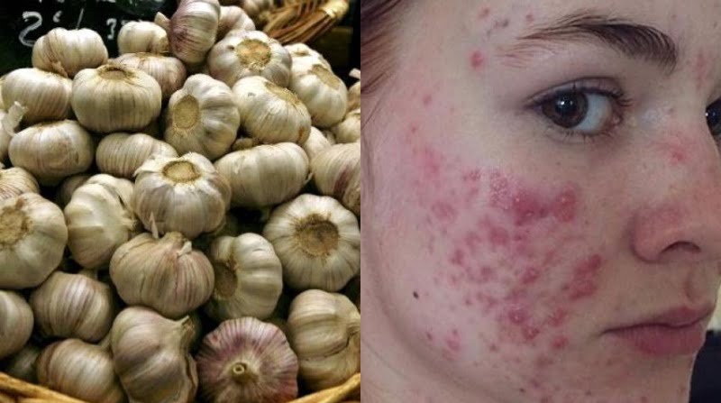  7 probleme rezolvate cu ajutorul usturoiului
