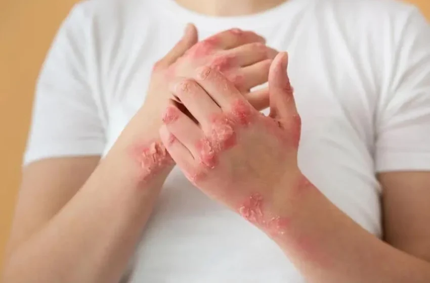  Creme naturale pentru psoriazis: încercați aceste rețete!