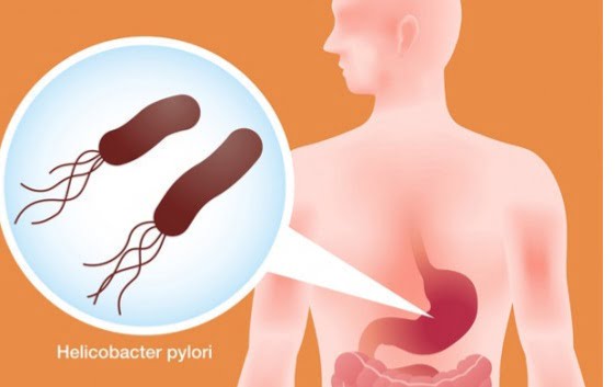  Simptomele Helicobacter pylori și un remediu japonez pentru a elimina rapid bacteria