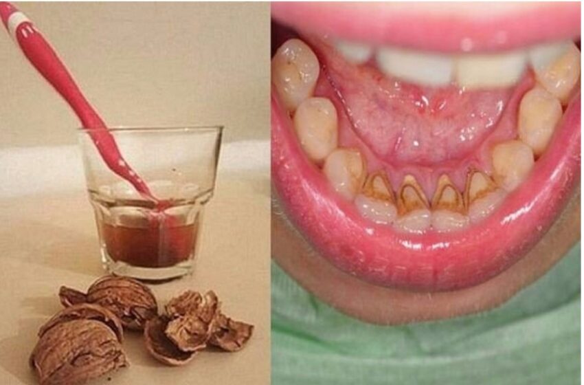  Cum să scapi de tartru cu 1 remediu simplu.