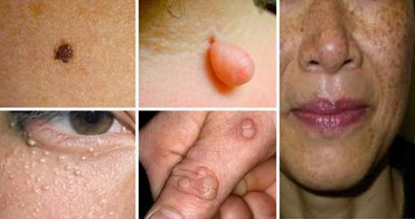  Distrugeți negii, alunițele, acneea și petele de vârstă cu aceste remedii naturale