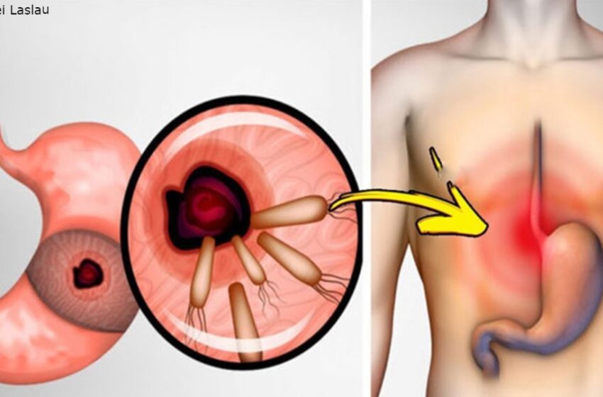  Iată cum să scapi de bacteriile care provoacă arsuri la stomac, ulcer și balonare pe care Helicobacter pylori  le provoacă