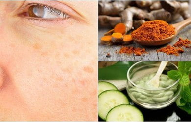  5 remedii casnice pentru a trata petele de vârstă în mod natural