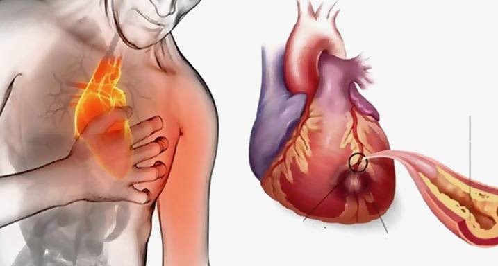  15 semne că ai arterele  înfundate cu colesterol