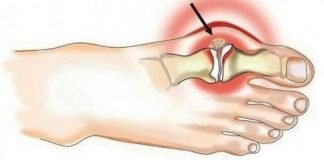  Cele mai puternice 5 remedii pentru îndepărtarea acidului uric din articulațiile dureroase!