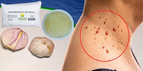  Ceapa, usturoiul și bicarbonatul: cel mai bun medicament pentru a elimina negii