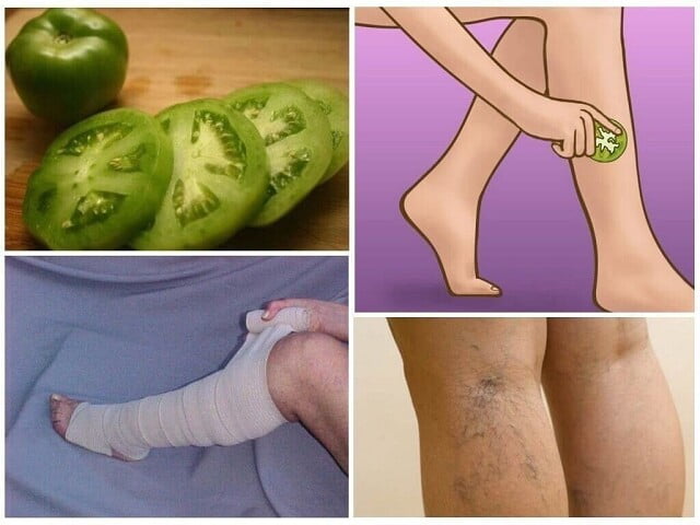  Cum poți vindeca natural varicele