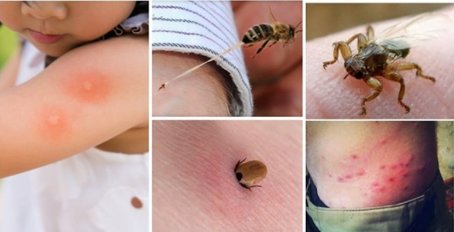  15 mușcături/înțepături de insecte pe care ar trebui să le știi