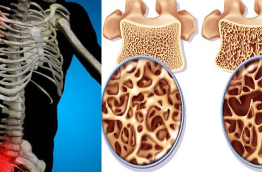  Sănătatea oaselor: 4 semne că sunteți expus riscului de osteoporoză