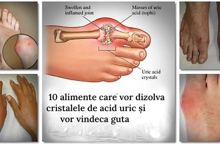  10 alimente care vor dizolva cristalele de acid uric și vor vindeca guta, pietrele la rinichi, durerile articulare