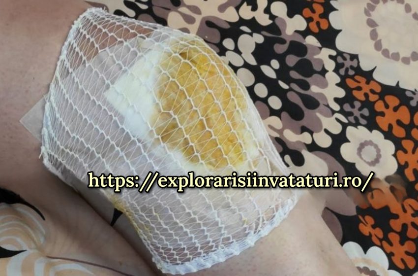  Proprietățile incredibile ale compresei cu ghimbir.