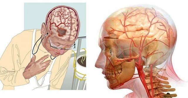  3 rețete -Aceste remedii vor îmbunătăți circulația sângelui în creier și vor ameliora durerile de cap, vor preveni demența și vor reduce riscul de accident vascular cerebral.