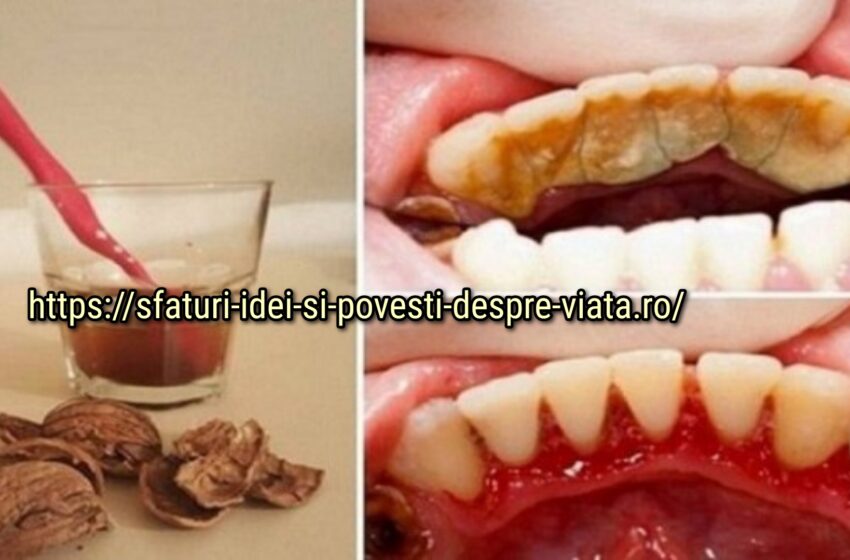  Scapati de placa, tartrul si sângerarea gingiilor intr-un mod usor si nedureros