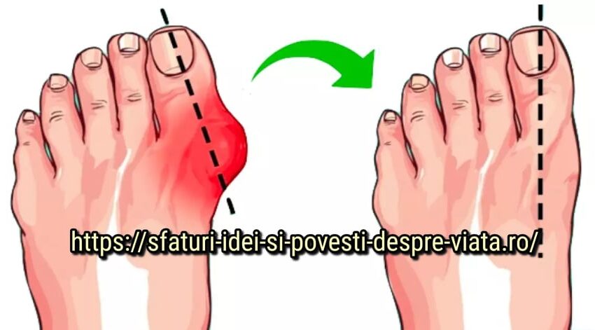  Remedii naturale pentru inflamație la picior – tratament pe bază de plante și nu numai