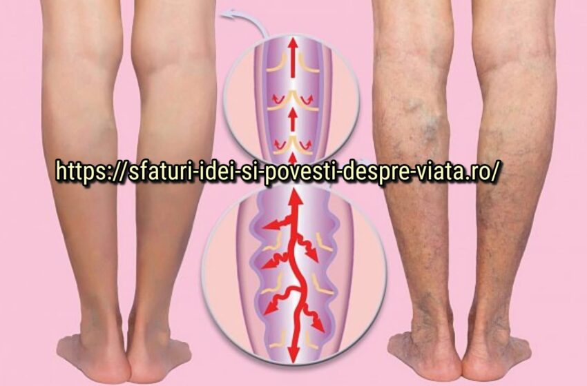 Tromboza și venele varicoase pot fi vindecate prin metode populare. Înțelepciunea strămoșilor