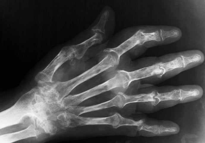  Acestea sunt primele simptome ale cancerului osos: boala debutează adesea fără semne, dar dacă observi acest lucru, mergi la medic