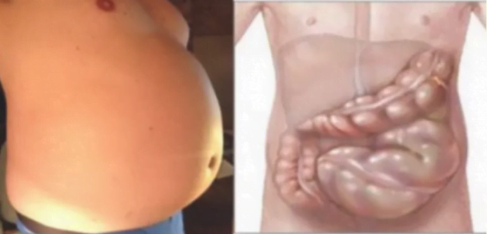  Burta mare-,, Nu ești gras, ești doar balonat”! 6 cauze care duc la balonare și remedii