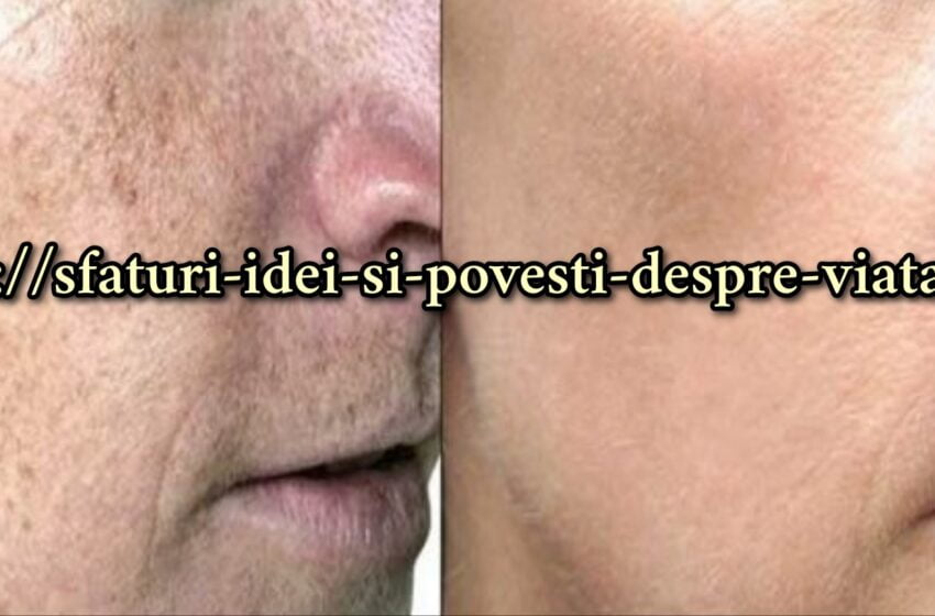  O modalitate simplă de a elimina petele de vârstă de pe piele și de a uniformiza tonul într-o săptămână cu lămâie și miere