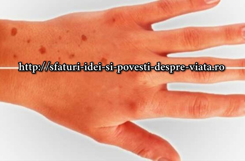  O modalitate ușoară de a scăpa de petele maro de pe piele! 