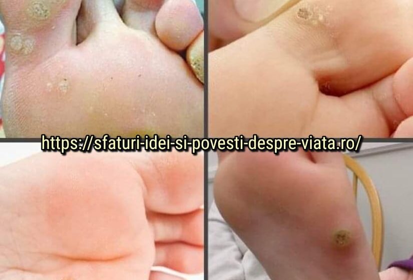  Așa au scăpat bunicile noastre de  negi și bătături