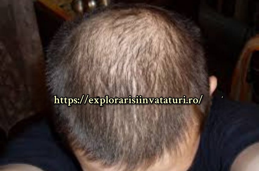  Cum i-am salvat părul soțului meu.Un tratament simplu și natural.