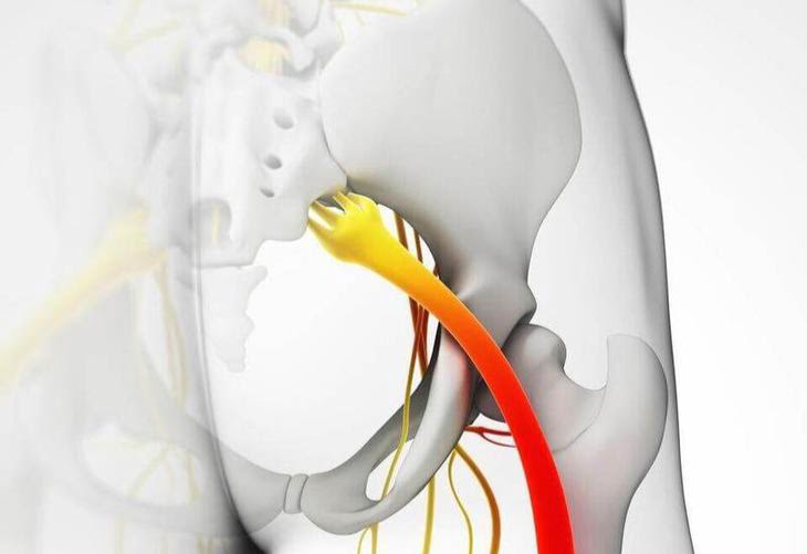  Nervul sciatic ciupit: 5 moduri de a ameliora durerea