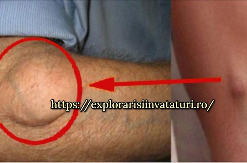  Nu trebuie să vă operați, iată cum puteți elimina aproape toate tipurile de chisturi