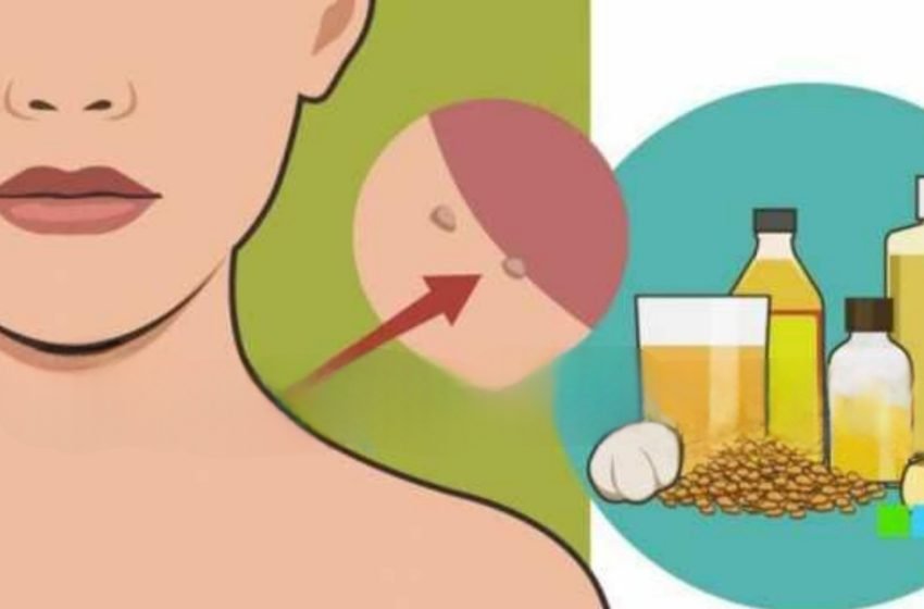  8 moduri simple de a elimina papiloamele fără a vizita un medic!