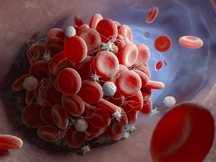  Cum să înțelegeți că s-a format un cheag de sânge în organism, purtând un pericol de moarte sub formă de accident vascular cerebral sau atac de cord, ce să faceți în acest caz?