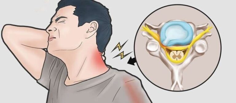  Hernia coloanei cervicale: simptome, diagnostic și tratament