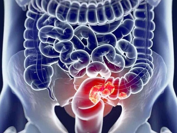  Ai grijă de intestinul tău! Oncologul a spus cum să minimizeze riscul de a dezvolta cancer colorectal.