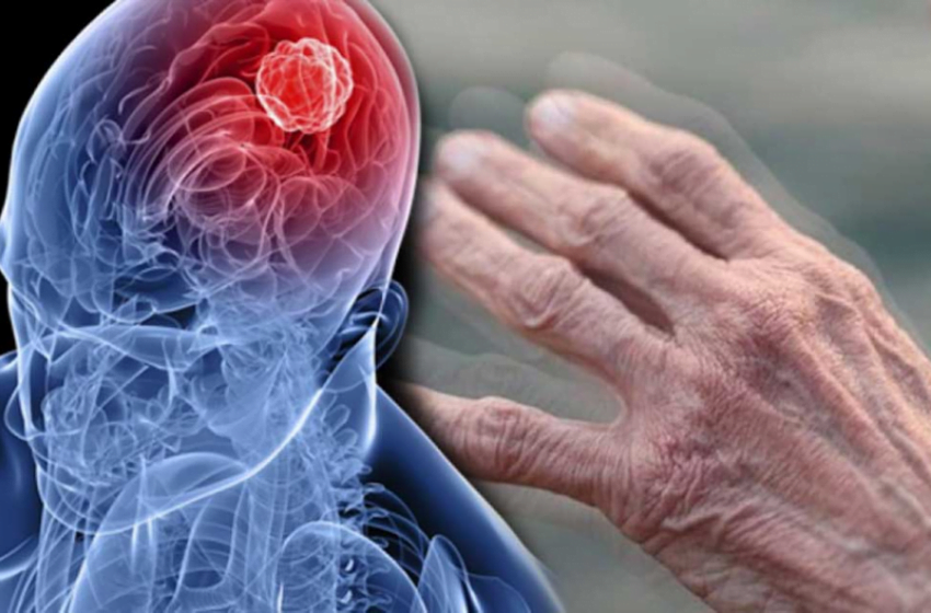  Parkinson. TOP 3 fapte pe care trebuie să le știi despre boală pentru a preveni