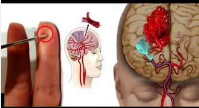  Aflați cum puteți acționa pentru a salva o persoană în cazul unui accident vascular cerebral folosind un ac
