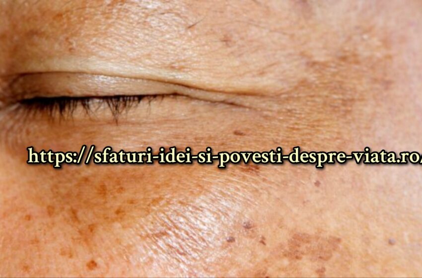  Tratament naturist pentru pistrui si pete maronii de pe fata. Puterea lămâii, a cepei ,pudra de migdale sau a untului de cacao depășește așteptările