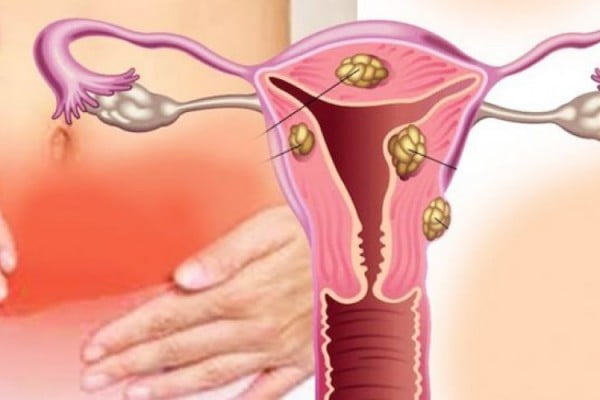  Aceste 5 alimente promovează creșterea fibroamelor! 7 simptome ale fibromului uterin și 8 sfaturi pentru a le reduce!