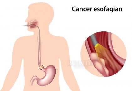  Tot ce trebuie să știți despre cancerul esofagian. Simptome, factori de risc, teste, tratament.