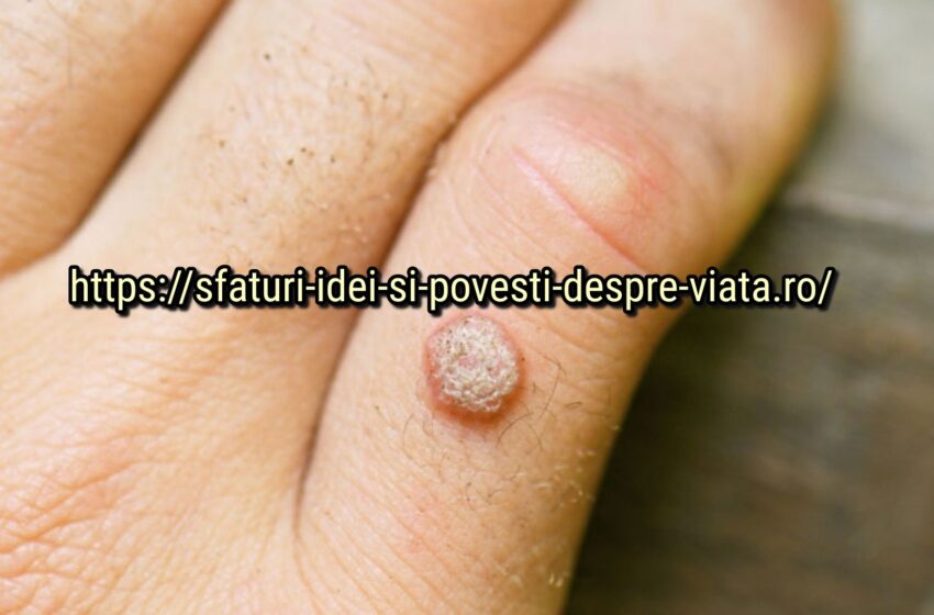  Îngrijirea naturală a pielii: eliminați petele de vârstă, alunițele, negii și punctele negre.