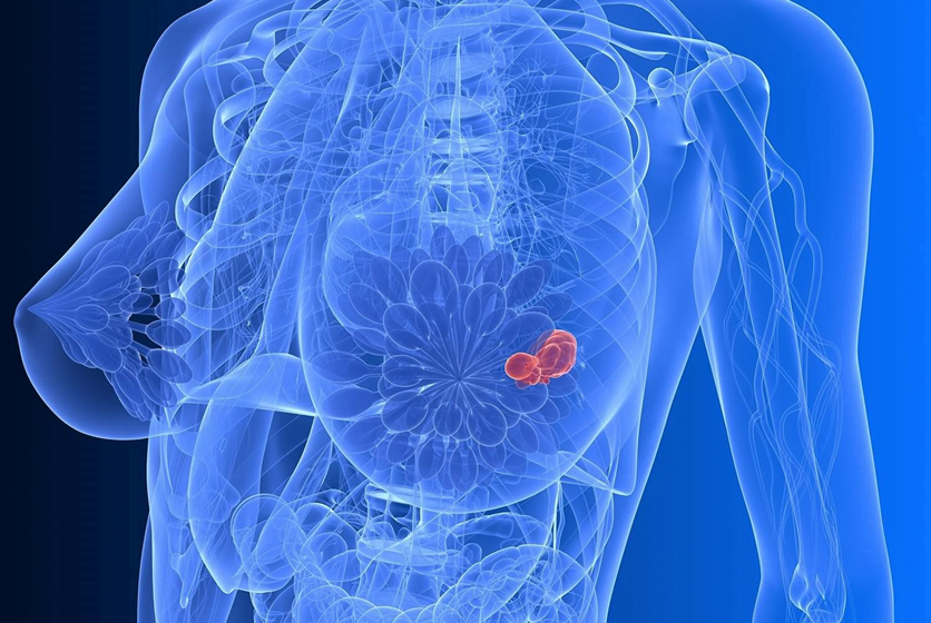  Tot ce trebuie să știi despre cancerul de sân. Cum să reduceți riscul: ne spune medicul