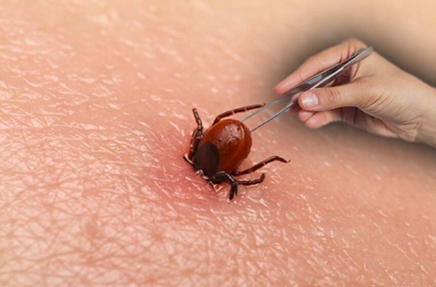  Cum sa scoți o căpuşă cu băţul de chibrit sau cu penseta