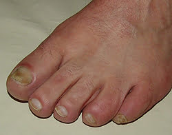  Unghia încarnată, pinten calcanean, ciuperca unghiei de la picioare. Cauzele, metodele și tratamentul cu remedii populare pentru unghii încarnate.