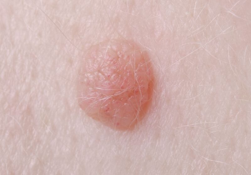  Tratamentul negilor prin metode naturale.