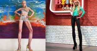  A cheltuit 150.000 de euro pentru a-și lungi picioarele cu 14 cm, în cele din urmă a regretat: